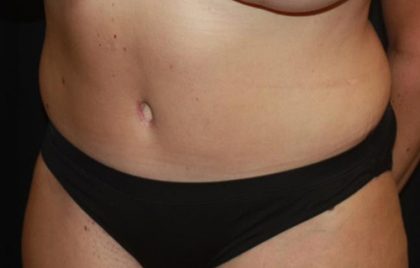 Tummy Tuck Before & After Patient #22399