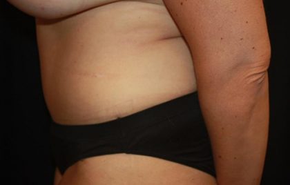 Tummy Tuck Before & After Patient #22399