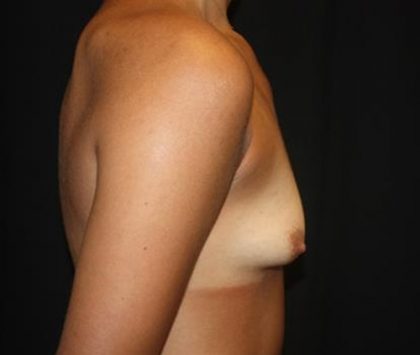 Breast Augmentation - Shaped Silicone Implants Before & After Patient #20540