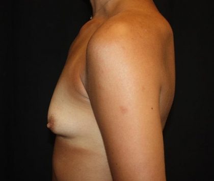 Breast Augmentation - Shaped Silicone Implants Before & After Patient #20540
