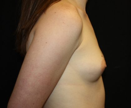 Breast Augmentation - Shaped Silicone Implants Before & After Patient #20541