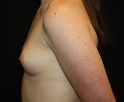 Breast Augmentation - Shaped Silicone Implants Before & After Patient #20541