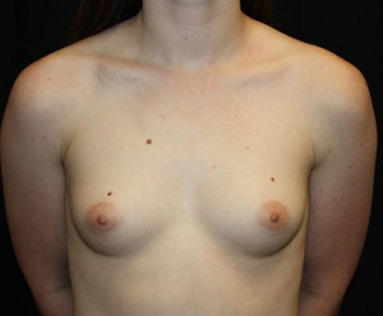 Breast Augmentation - Shaped Silicone Implants Before & After Patient #20541