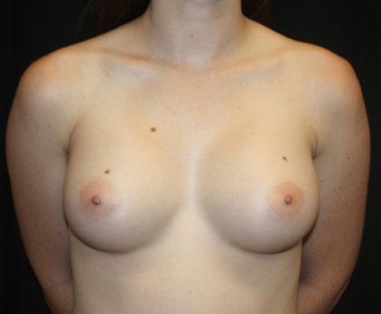 Breast Augmentation - Shaped Silicone Implants Before & After Patient #20541