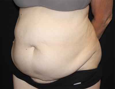 Tummy Tuck Before & After Patient #22651