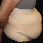 Tummy Tuck Before & After Patient #22651