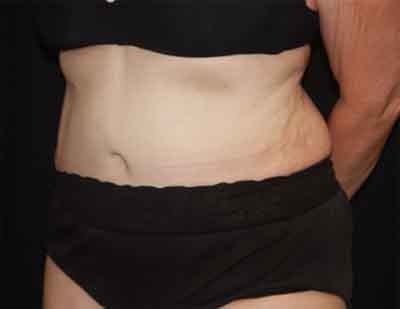 Tummy Tuck Before & After Patient #22651