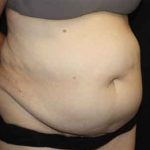 Tummy Tuck Before & After Patient #22651