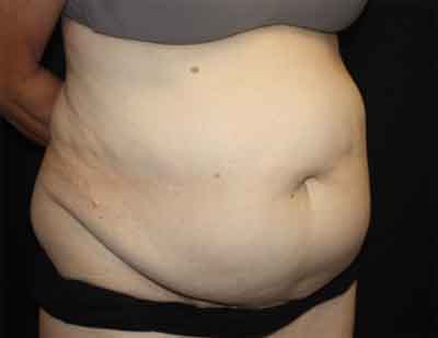 Tummy Tuck Before & After Patient #22651