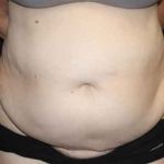 Tummy Tuck Before & After Patient #22651