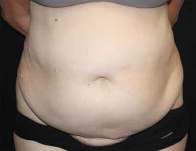 Tummy Tuck Before & After Patient #22651