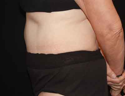Tummy Tuck Before & After Patient #22651