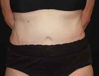 Tummy Tuck Before & After Patient #22651