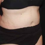 Tummy Tuck Before & After Patient #22651