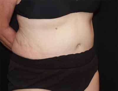 Tummy Tuck Before & After Patient #22651