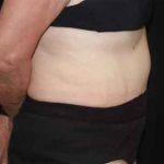 Tummy Tuck Before & After Patient #22651