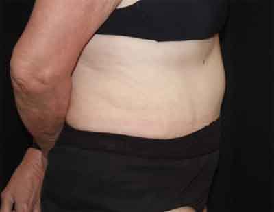 Tummy Tuck Before & After Patient #22651