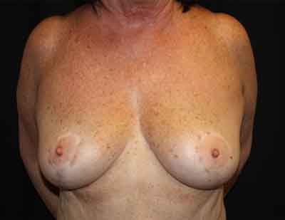 Breast Reduction Before & After Patient #23578