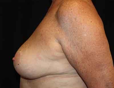 Breast Reduction Before & After Patient #23578