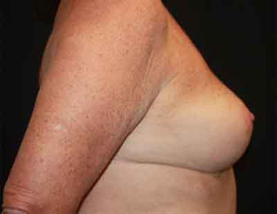 Breast Reduction Before & After Patient #23578