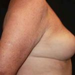Breast Lift Before & After Patient #20977