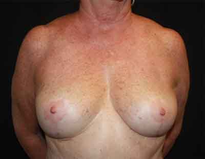 Breast Reduction Before & After Patient #23578