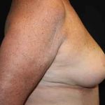 Breast Reduction Before & After Patient #23578