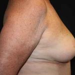 Breast Lift Before & After Patient #20977