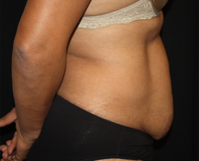 Tummy Tuck Before & After Patient #22663