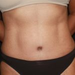 Tummy Tuck Before & After Patient #22663