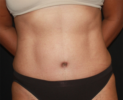 Tummy Tuck Before & After Patient #22663