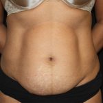 Tummy Tuck Before & After Patient #22663