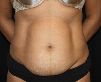 Tummy Tuck Before & After Patient #22663
