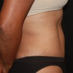 Tummy Tuck Before & After Patient #22663