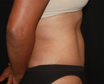 Tummy Tuck Before & After Patient #22663