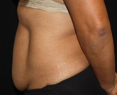 Tummy Tuck Before & After Patient #22663
