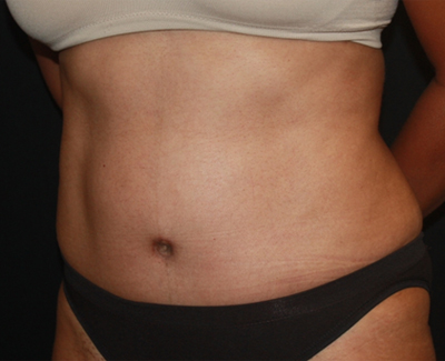 Tummy Tuck Before & After Patient #22663