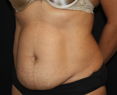 Tummy Tuck Before & After Patient #22663