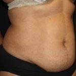 Tummy Tuck Before & After Patient #22663