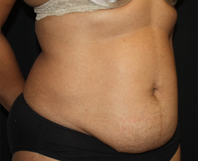 Tummy Tuck Before & After Patient #22663