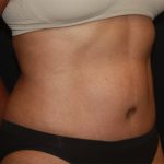 Tummy Tuck Before & After Patient #22663