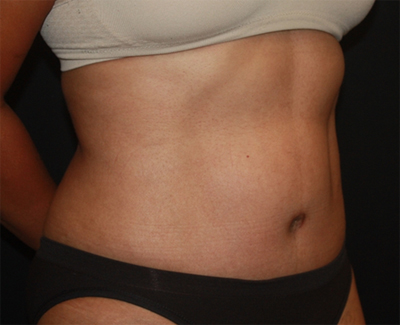 Tummy Tuck Before & After Patient #22663