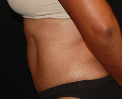 Tummy Tuck Before & After Patient #22663