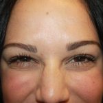 Botox and Dysport Before & After Patient #24720
