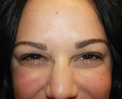 Botox and Dysport Before & After Patient #24720