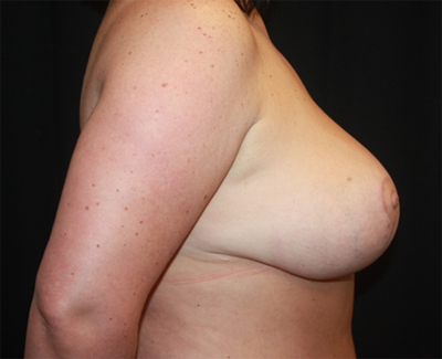 Breast Reduction Before & After Patient #23699