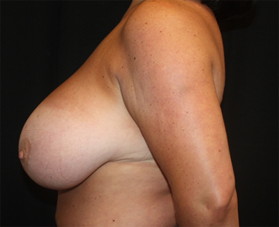 Breast Reduction Before & After Patient #23699