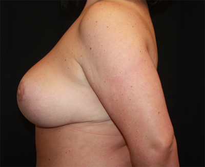 Breast Reduction Before & After Patient #23699