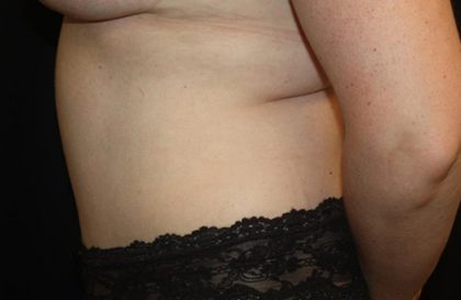 Tummy Tuck Before & After Patient #22437