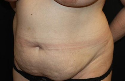 Tummy Tuck Before & After Patient #22437